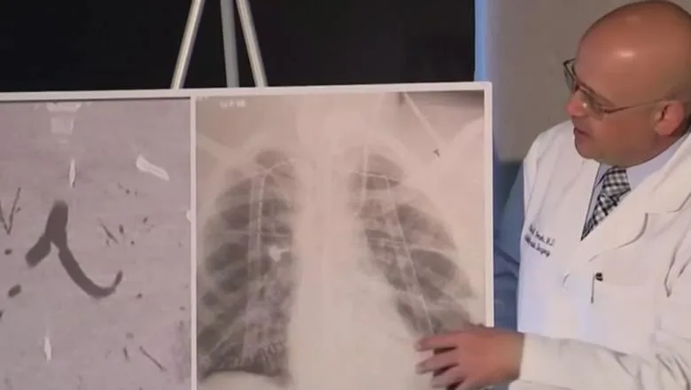 Dublu transplant de plămâni pentru o tânără de 20 de ani