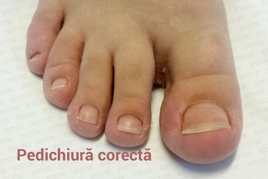 Pedichiura-corecta-Unghie-incarnata