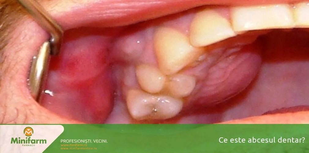 Cand si cum apare abcesul dentar
