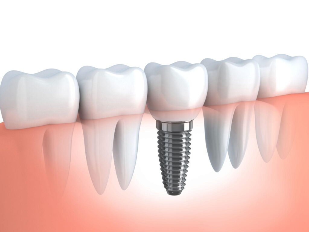 implant-dentar