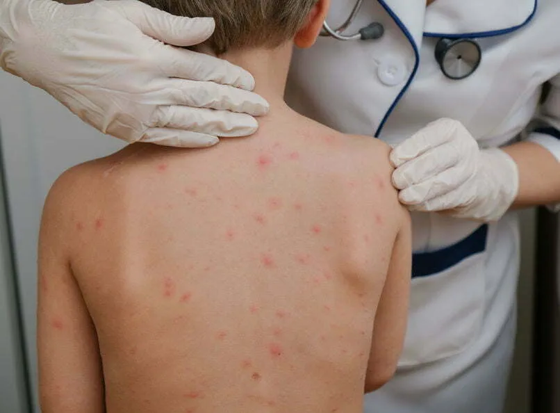 Peste 50 de cazuri de varicelă înregistrate în şcoli şi grădiniţe in Gorj