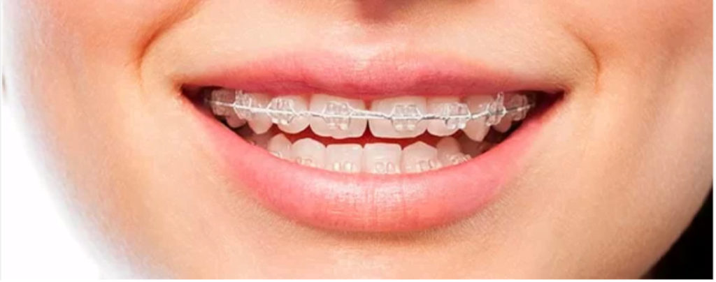 aparat-dentar