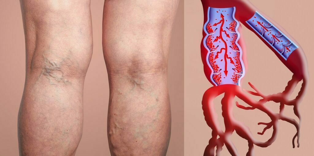 Varicose,Veins,On,A,Female,Senior,Legs.,The,Structure,Of