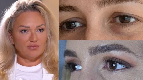 Ce este şi cum se tratează blefaroplastia superioară şi inferioară?