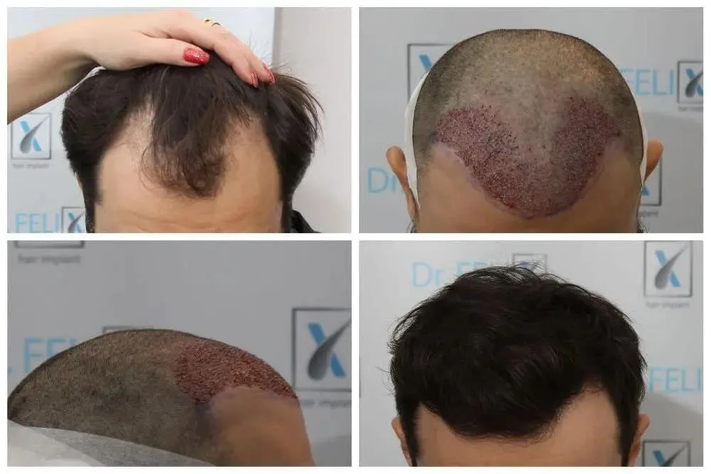 Transplant de par de calitate și condiții excelente la Dr. Felix Hair Implant