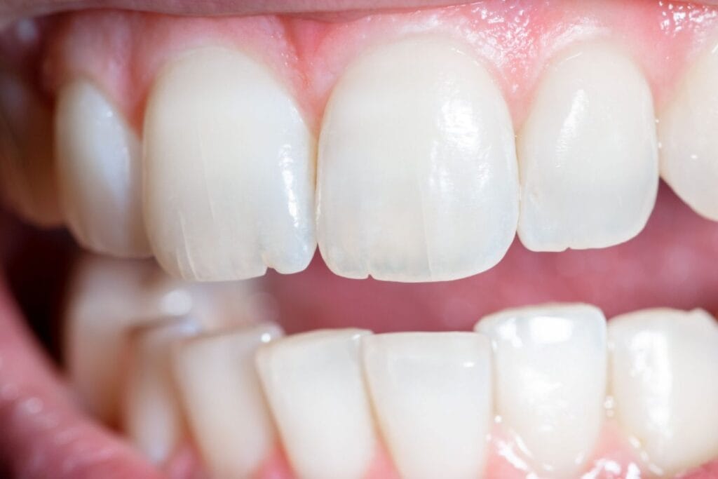 greseli care afecteaza lucrarea dentara