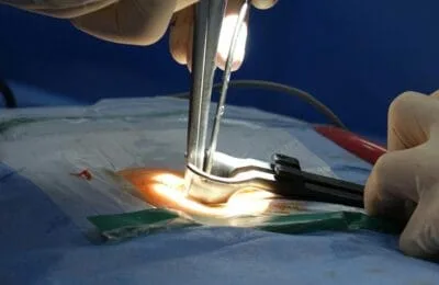 Coșmar medical: Bărbat, operat de 4 ori de hernie, încă suferă. Ce au descoperit medicii?
