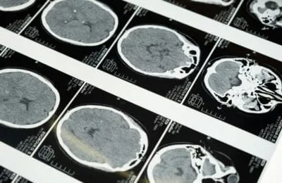Toxoplasmoza – Parazitul adormit” e, de fapt, hiperactiv. Detalii!