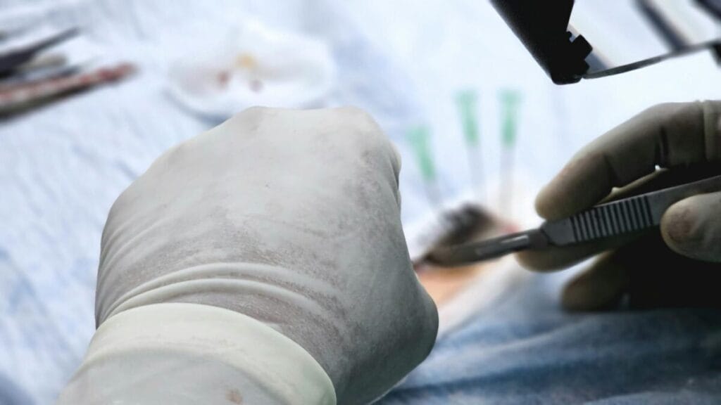 transplant facial