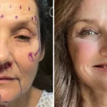 Fiica Lorettei Lynn - Operatie estetica de 20.000$ in Mexic. A ignorat sfaturile?