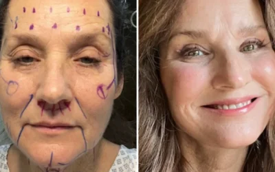 Fiica Lorettei Lynn – Operatie estetica de 20.000$ in Mexic. A ignorat sfaturile?