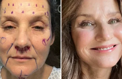 Fiica Lorettei Lynn – Operatie estetica de 20.000$ in Mexic. A ignorat sfaturile?