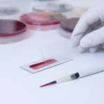 Leucemie - 96% supraviețuire cu o nouă metodă. Speranțe din sângele ombilical