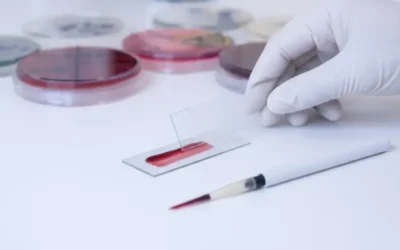 Leucemie – 96% supraviețuire cu o nouă metodă. Speranțe din sângele ombilical