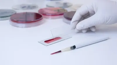 Leucemie – 96% supraviețuire cu o nouă metodă. Speranțe din sângele ombilical