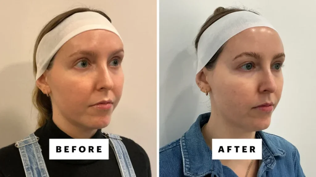 lifting facial