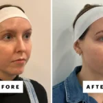 Lifting facial cu 2.000 de dolari, noua obsesie a vedetelor. Cum funcționează XERF