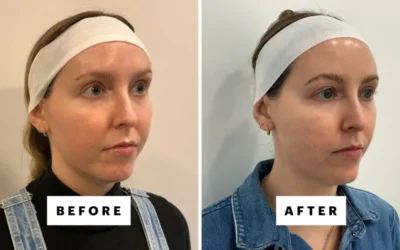 Lifting facial cu 2.000 de dolari, noua obsesie a vedetelor. Cum funcționează XERF