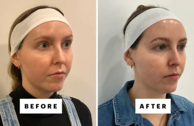 Lifting facial cu 2.000 de dolari, noua obsesie a vedetelor. Cum funcționează XERF