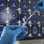 Demența - Te avertizează cu 20 de ani înainte. Semne subtile ignorate