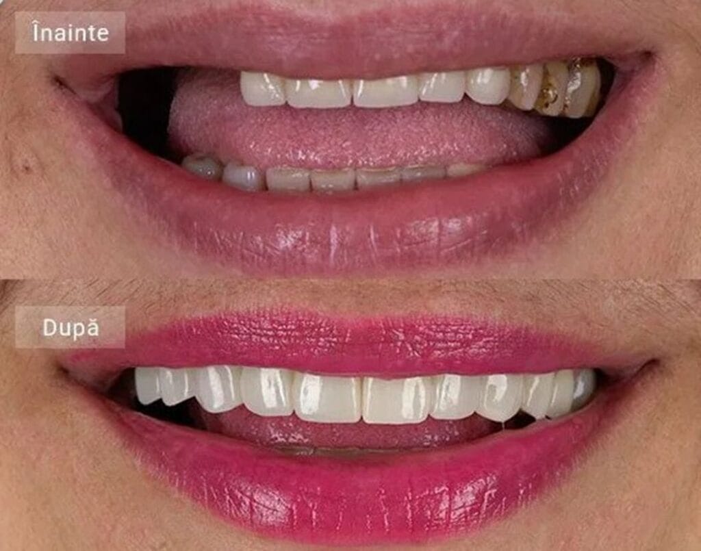 4 stiri.com.ro Cat costa implantul dentar in Germania, cat costa in Bucuresti